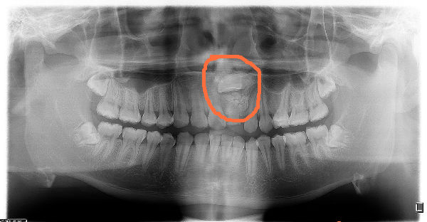 盐城市口腔医院成功完成一例上前牙埋伏阻生伴牙瘤手术